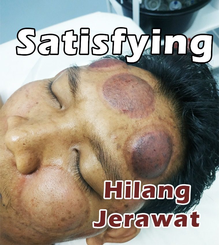 Bekam Jerawat